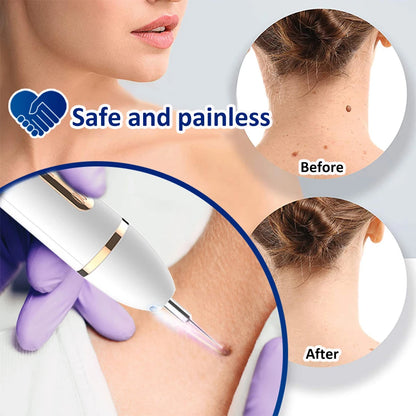 Laser Plasma Pen – Remove Dark Spots, Moles & Skin Tags Instantly!