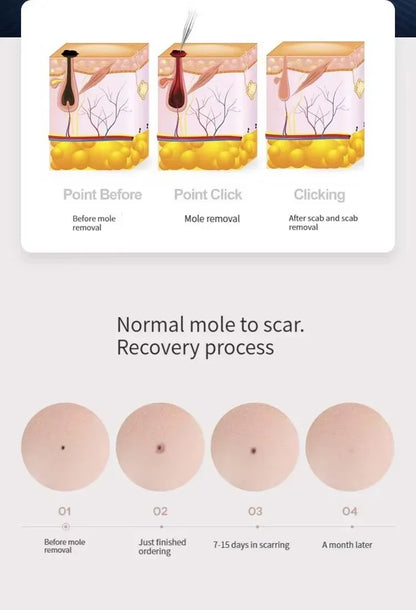 Plasma Laser Pen – Remove Spots & Rejuvenate Instantly!