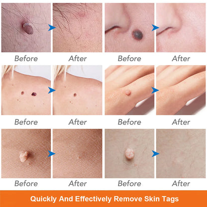 Laser Plasma Pen – Remove Dark Spots, Moles & Skin Tags Instantly!