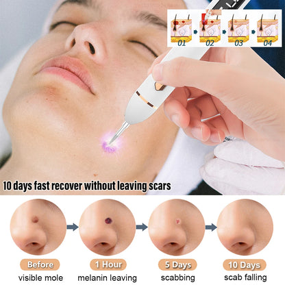 Laser Plasma Pen – Remove Dark Spots, Moles & Skin Tags Instantly!